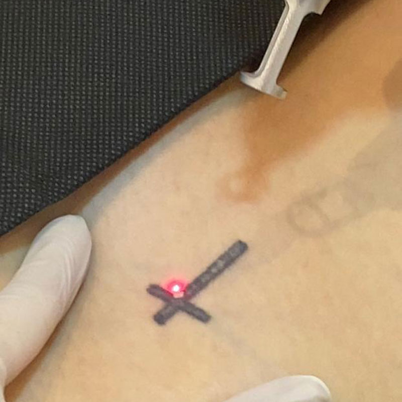 REMOCION-DE-TATUAJE