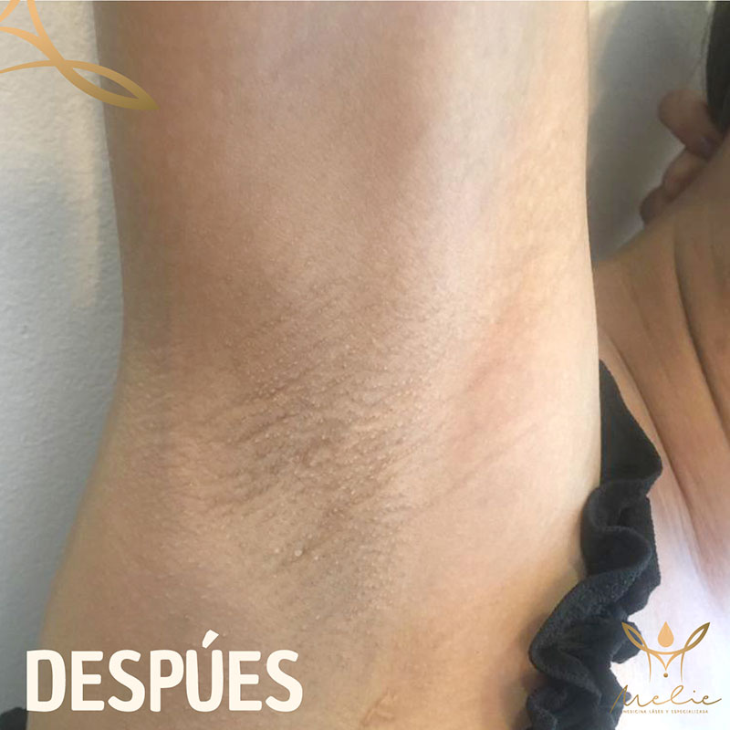despues